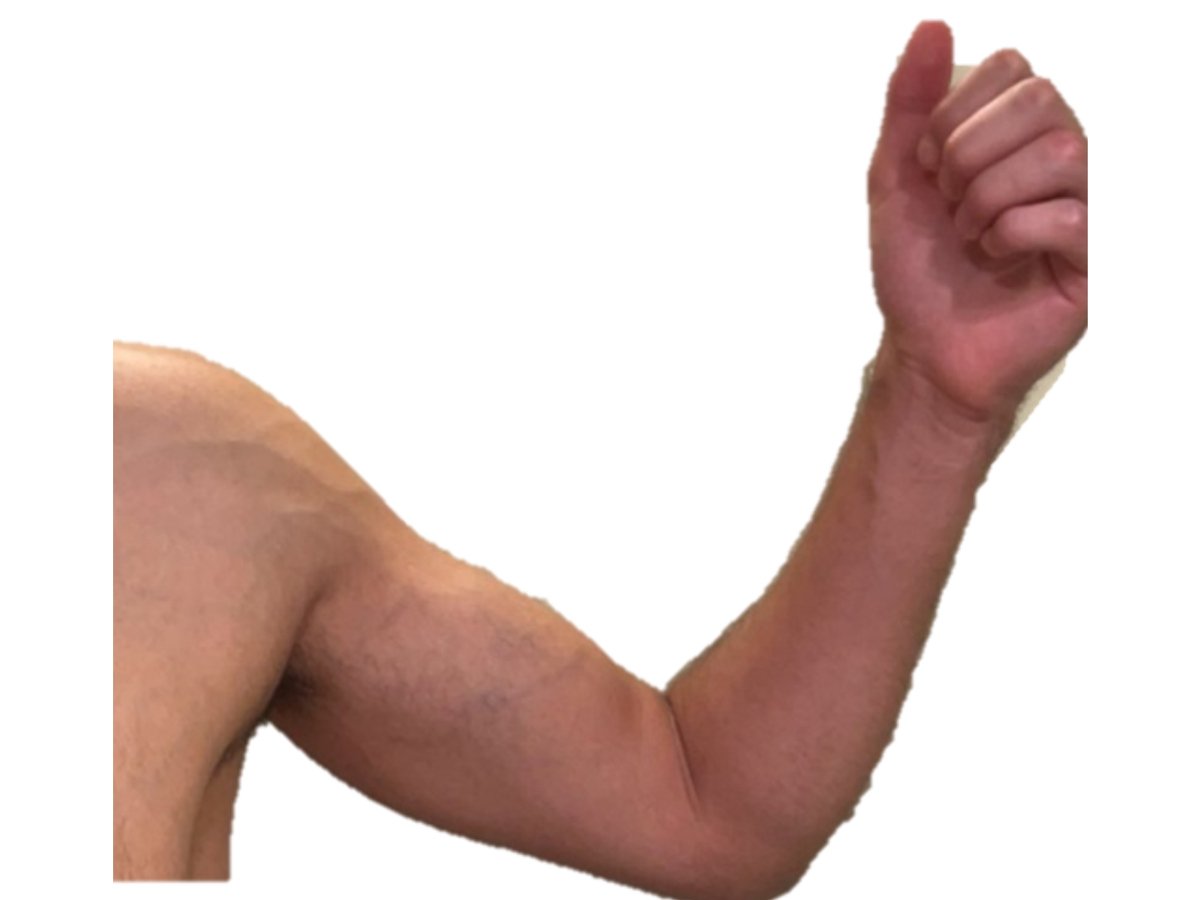 illustration av arm där hand och överarm hålls upp, svullnad i överarm