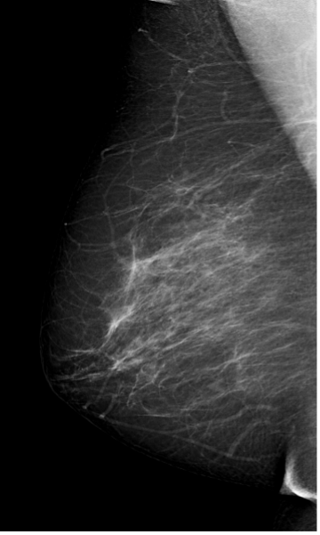 lättbedömd mammografi