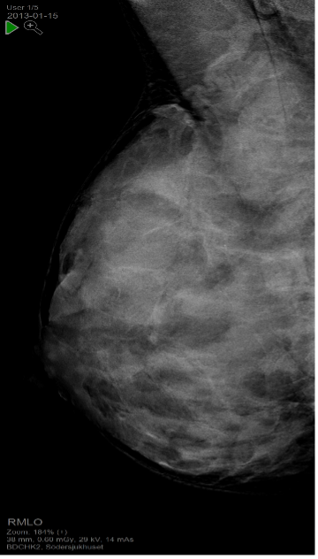 svårbedömd mammografi