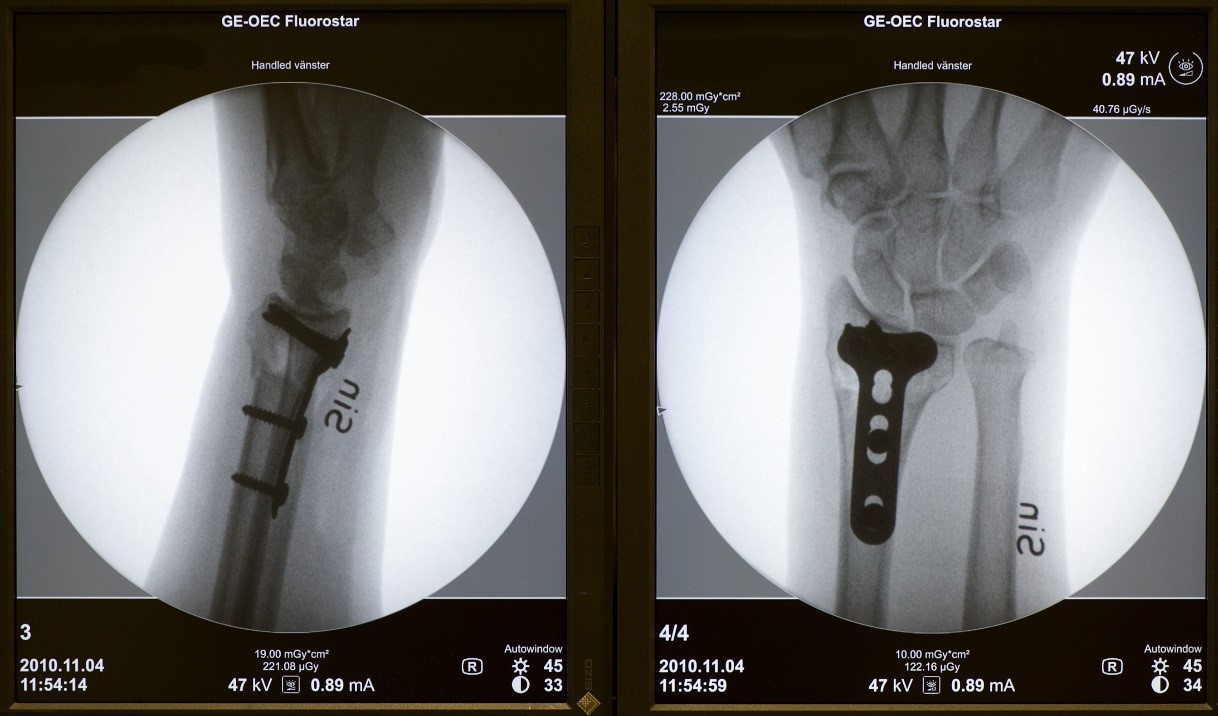 Röntgenbild på opererad handled